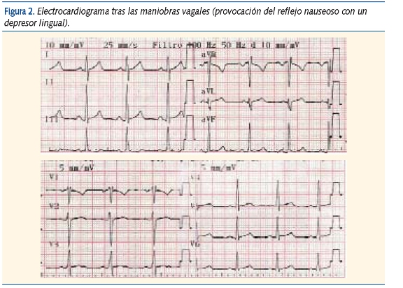 Figura 2. Electrocardiograma tras las maniobras vagales (provocación del reflejo nauseoso con un
depresor lingual).